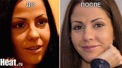 Елена Беркова сделала очередную пластическую операцию (ФОТО) Елена Беркова сделала очередную пластическую операцию (ФОТО)